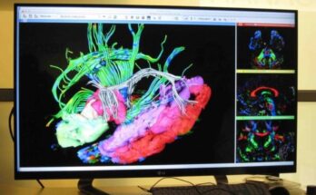 Experts suggest that 13% of treatable conditions are misdiagnosed as dementia